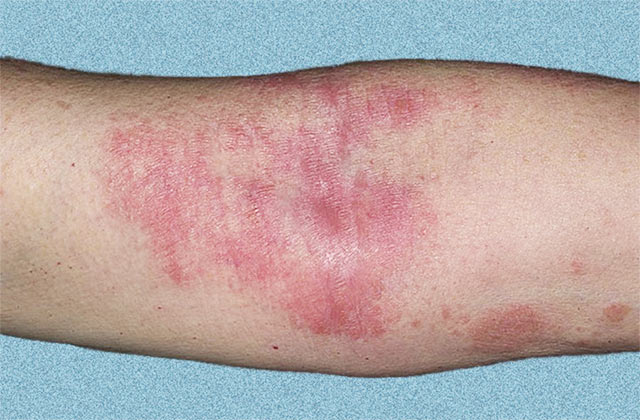 Атопический дерматит у ребенка в первую очередь проявляется повреждением кожи. Основными симптомами заболевания считаются: