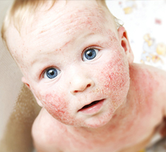 Дерматит у детей бывает следующих видов:  аллергический дерматит – заболевание, появление которого спровоцировано повторным воздействием аллергена на организм; контактный дерматит – появляется в местах контакта кожи с аллергеном; солнечный – возникает из-за длительного воздействия ультрафиолетовых лучей на кожный покров; себорейный дерматит – болезнь, характеризующаяся появлением чешуйчатых высыпаний на волосяном покрове эпидермиса головы, которые распространяются на лицо, шею, верхние конечности и иные участки тела.
