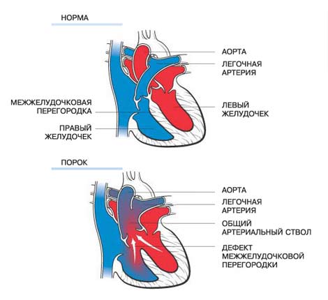 Система из сердца и сосудов ребенка закладывается в первые два месяца внутриутробного развития. Воздействие на организм женщины неблагоприятных факторов в этот период чаще всего и приводит к аномалиям в структурах сердца и коронарных сосудов.